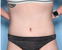 Body Lift Before & After Patient #34335